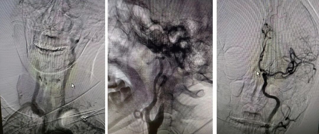导丝怎么扩【载药时代 球扩天下】NOVA DES®颅内药物洗脱支架在大脑中动脉重度狭窄的应用二例！_https://www.jmylbn.com_新闻资讯_第5张