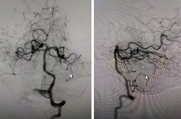 导丝怎么扩【载药时代 球扩天下】NOVA DES®颅内药物洗脱支架在大脑中动脉重度狭窄的应用二例！_https://www.jmylbn.com_新闻资讯_第6张