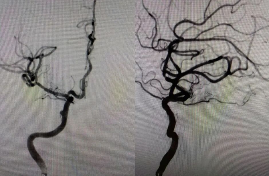 导丝怎么扩【载药时代 球扩天下】NOVA DES®颅内药物洗脱支架在大脑中动脉重度狭窄的应用二例！_https://www.jmylbn.com_新闻资讯_第16张