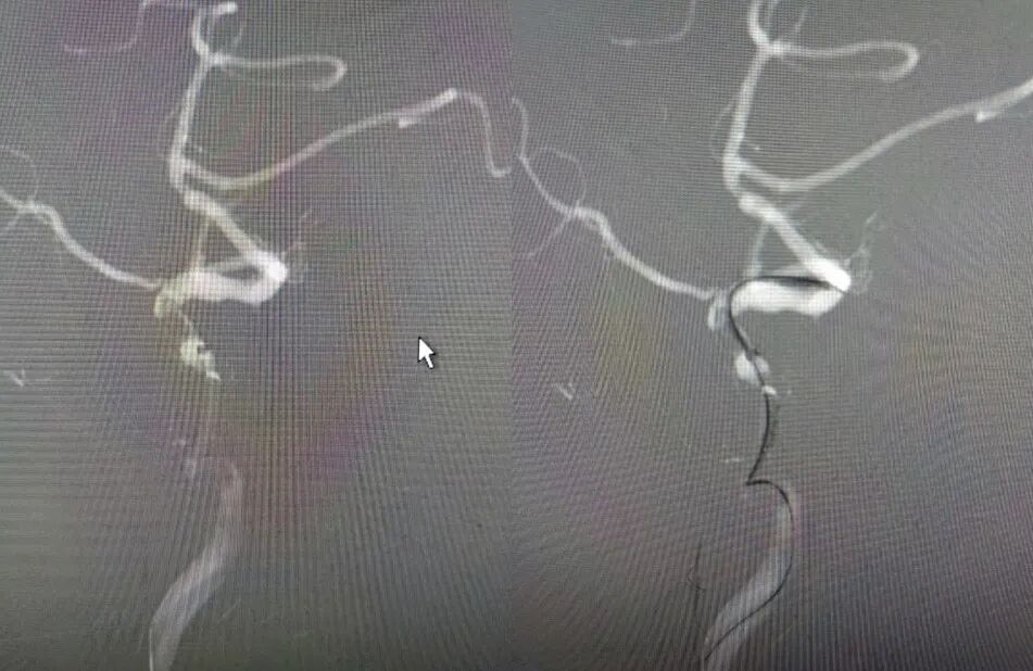 导丝怎么扩【载药时代 球扩天下】NOVA DES®颅内药物洗脱支架在大脑中动脉重度狭窄的应用二例！_https://www.jmylbn.com_新闻资讯_第8张