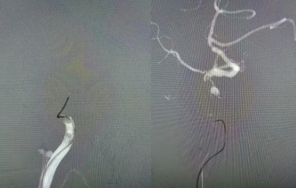 导丝怎么扩【载药时代 球扩天下】NOVA DES®颅内药物洗脱支架在大脑中动脉重度狭窄的应用二例！_https://www.jmylbn.com_新闻资讯_第7张