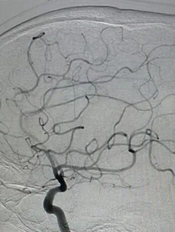 导丝怎么扩【载药时代 球扩天下】NOVA DES®颅内药物洗脱支架在大脑中动脉重度狭窄的应用二例！_https://www.jmylbn.com_新闻资讯_第31张