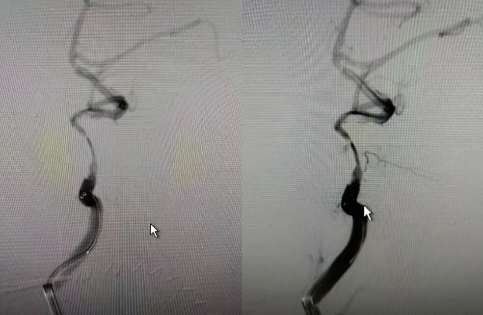 导丝怎么扩【载药时代 球扩天下】NOVA DES®颅内药物洗脱支架在大脑中动脉重度狭窄的应用二例！_https://www.jmylbn.com_新闻资讯_第10张