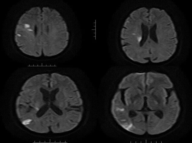 导丝怎么扩【载药时代 球扩天下】NOVA DES®颅内药物洗脱支架在大脑中动脉重度狭窄的应用二例！_https://www.jmylbn.com_新闻资讯_第23张