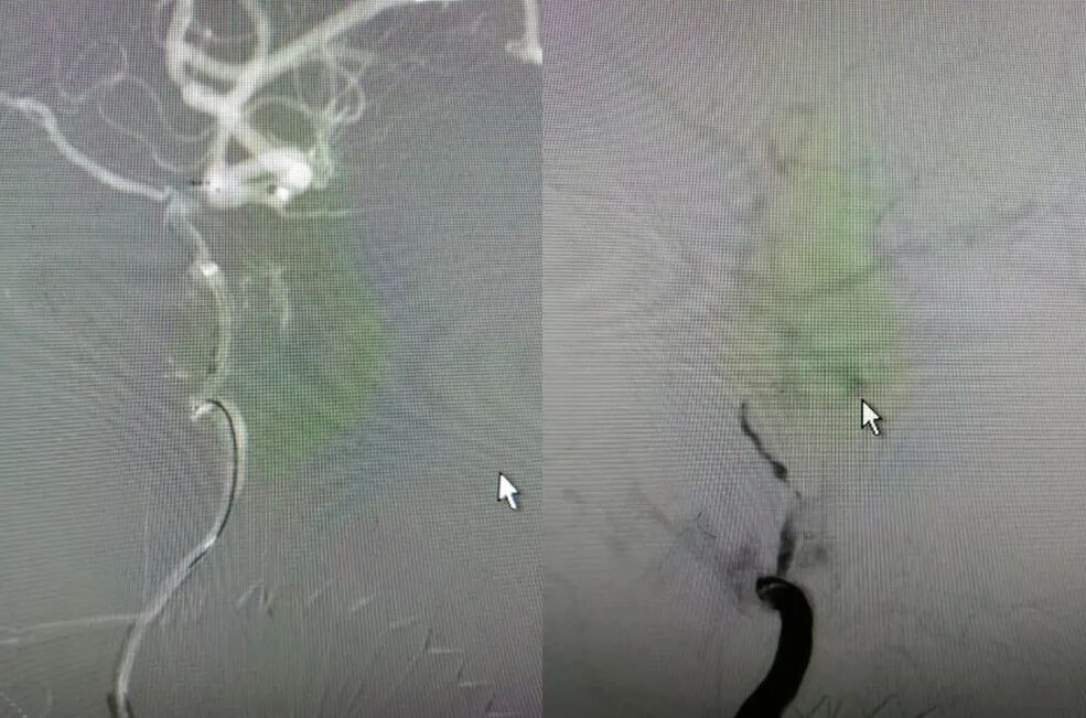 导丝怎么扩【载药时代 球扩天下】NOVA DES®颅内药物洗脱支架在大脑中动脉重度狭窄的应用二例！_https://www.jmylbn.com_新闻资讯_第9张