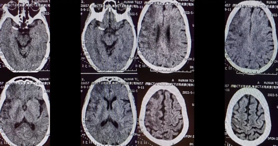 导丝怎么扩【载药时代 球扩天下】NOVA DES®颅内药物洗脱支架在大脑中动脉重度狭窄的应用二例！_https://www.jmylbn.com_新闻资讯_第18张