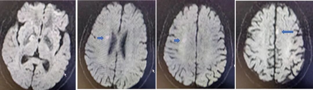 导丝怎么扩【载药时代 球扩天下】NOVA DES®颅内药物洗脱支架在大脑中动脉重度狭窄的应用二例！_https://www.jmylbn.com_新闻资讯_第3张