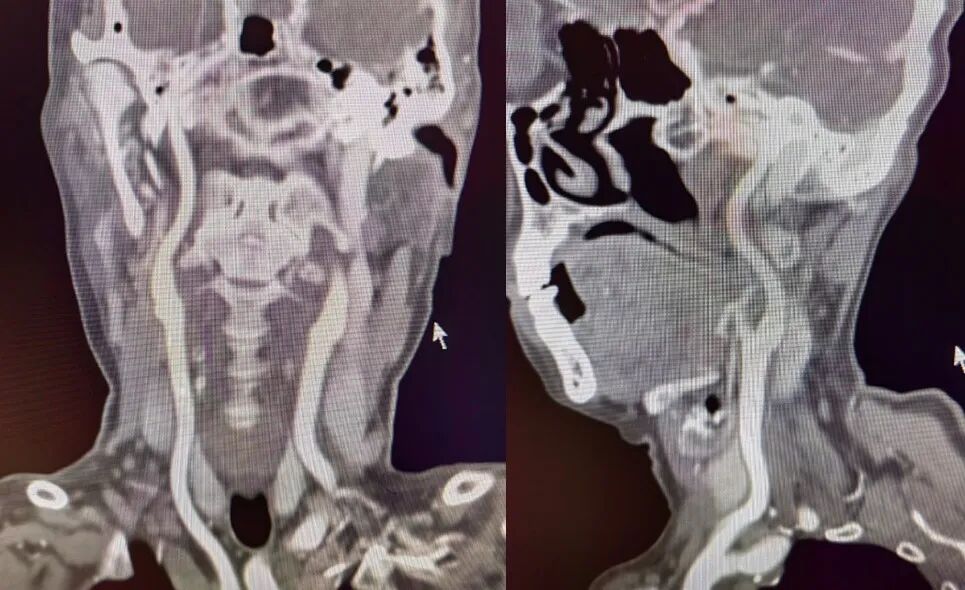 导丝怎么扩【载药时代 球扩天下】NOVA DES®颅内药物洗脱支架在大脑中动脉重度狭窄的应用二例！_https://www.jmylbn.com_新闻资讯_第19张