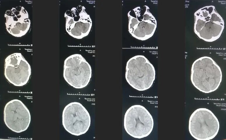 导丝怎么扩【载药时代 球扩天下】NOVA DES®颅内药物洗脱支架在颈内动脉颅内段重度狭窄的应用两例！滕州市中心医院&山西医科大学第二医院_https://www.jmylbn.com_新闻资讯_第3张