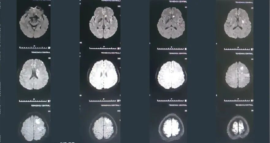 导丝怎么扩【载药时代 球扩天下】NOVA DES®颅内药物洗脱支架在颈内动脉颅内段重度狭窄的应用两例！滕州市中心医院&山西医科大学第二医院_https://www.jmylbn.com_新闻资讯_第10张