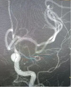 导丝怎么扩【载药时代 球扩天下】NOVA DES®颅内药物洗脱支架在颈内动脉颅内段重度狭窄的应用两例！滕州市中心医院&山西医科大学第二医院_https://www.jmylbn.com_新闻资讯_第7张