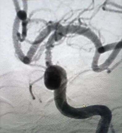 导丝怎么扩【载药时代 球扩天下】NOVA DES®颅内药物洗脱支架在颈内动脉颅内段重度狭窄的应用两例！滕州市中心医院&山西医科大学第二医院_https://www.jmylbn.com_新闻资讯_第9张