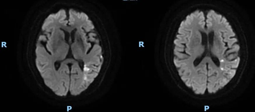 导丝怎么扩【载药时代 球扩天下】NOVA DES®颅内药物洗脱支架在颈内动脉颅内段重度狭窄的应用二例！_https://www.jmylbn.com_新闻资讯_第25张