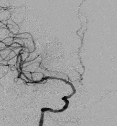 导丝怎么扩【载药时代 球扩天下】NOVA DES®颅内药物洗脱支架在颈内动脉颅内段重度狭窄的应用二例！_https://www.jmylbn.com_新闻资讯_第16张