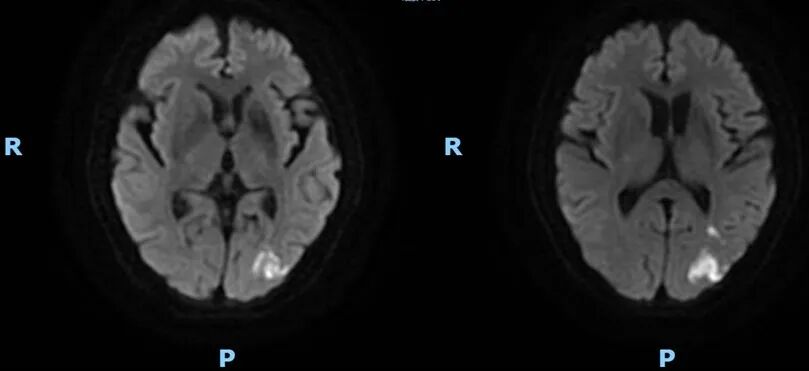 导丝怎么扩【载药时代 球扩天下】NOVA DES®颅内药物洗脱支架在颈内动脉颅内段重度狭窄的应用二例！_https://www.jmylbn.com_新闻资讯_第23张