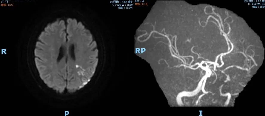 导丝怎么扩【载药时代 球扩天下】NOVA DES®颅内药物洗脱支架在颈内动脉颅内段重度狭窄的应用二例！_https://www.jmylbn.com_新闻资讯_第24张