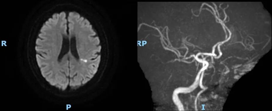 导丝怎么扩【载药时代 球扩天下】NOVA DES®颅内药物洗脱支架在颈内动脉颅内段重度狭窄的应用二例！_https://www.jmylbn.com_新闻资讯_第26张
