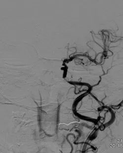 导丝怎么扩重磅！NOVA颅内药物球扩支架湖北首例植入！_https://www.jmylbn.com_新闻资讯_第9张