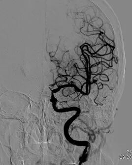 导丝怎么扩重磅！NOVA颅内药物球扩支架湖北首例植入！_https://www.jmylbn.com_新闻资讯_第13张
