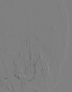 导丝怎么扩重磅！NOVA颅内药物球扩支架湖北首例植入！_https://www.jmylbn.com_新闻资讯_第10张