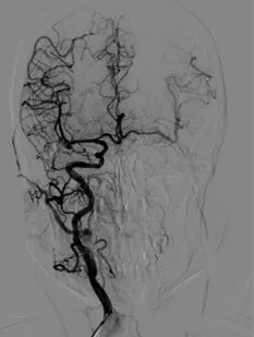 导丝怎么扩重磅！NOVA颅内药物球扩支架湖北首例植入！_https://www.jmylbn.com_新闻资讯_第6张