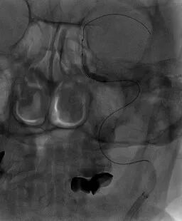 导丝怎么扩重磅！NOVA颅内药物球扩支架湖北首例植入！_https://www.jmylbn.com_新闻资讯_第11张