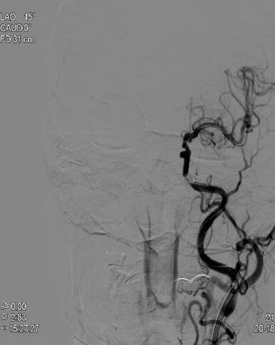 导丝怎么扩重磅！NOVA颅内药物球扩支架湖北首例植入！_https://www.jmylbn.com_新闻资讯_第8张