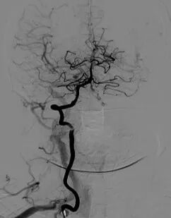 导丝怎么扩重磅！NOVA颅内药物球扩支架湖北首例植入！_https://www.jmylbn.com_新闻资讯_第7张