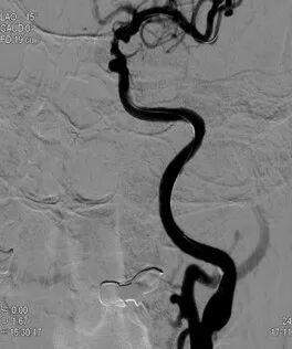导丝怎么扩重磅！NOVA颅内药物球扩支架湖北首例植入！_https://www.jmylbn.com_新闻资讯_第12张