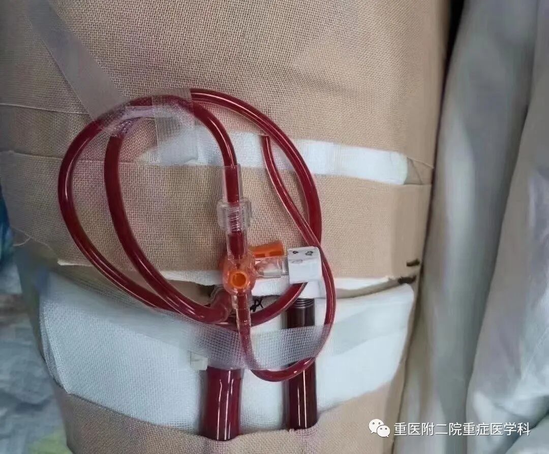 医疗监测性管道有哪些【重症科普你我他】之浅识ICU常见管道_https://www.jmylbn.com_新闻资讯_第38张