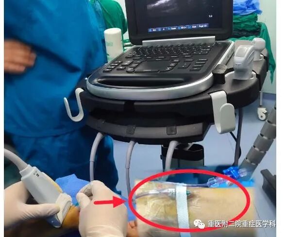 医疗监测性管道有哪些【重症科普你我他】之浅识ICU常见管道_https://www.jmylbn.com_新闻资讯_第15张