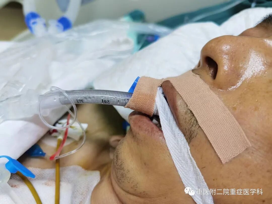 医疗监测性管道有哪些【重症科普你我他】之浅识ICU常见管道_https://www.jmylbn.com_新闻资讯_第9张