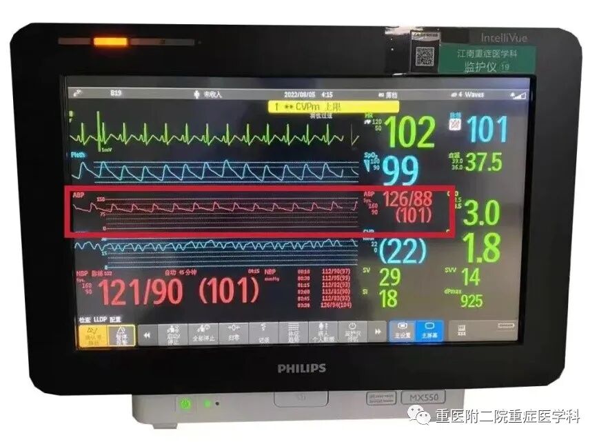 医疗监测性管道有哪些【重症科普你我他】之浅识ICU常见管道_https://www.jmylbn.com_新闻资讯_第16张