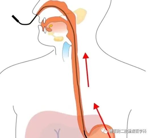 医疗监测性管道有哪些【重症科普你我他】之浅识ICU常见管道_https://www.jmylbn.com_新闻资讯_第30张