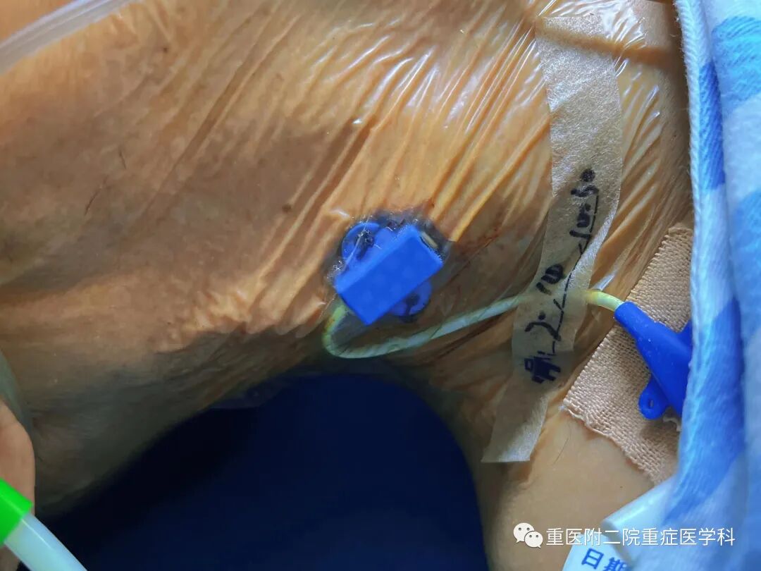 医疗监测性管道有哪些【重症科普你我他】之浅识ICU常见管道_https://www.jmylbn.com_新闻资讯_第24张