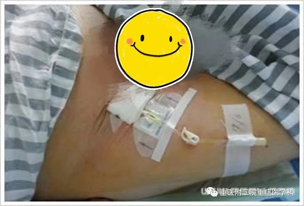 医疗监测性管道有哪些【重症科普你我他】之浅识ICU常见管道_https://www.jmylbn.com_新闻资讯_第21张