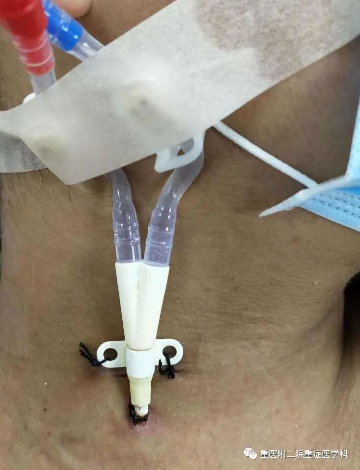 医疗监测性管道有哪些【重症科普你我他】之浅识ICU常见管道_https://www.jmylbn.com_新闻资讯_第32张