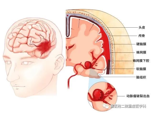 【重症科普你我他】之可怕的脑出血