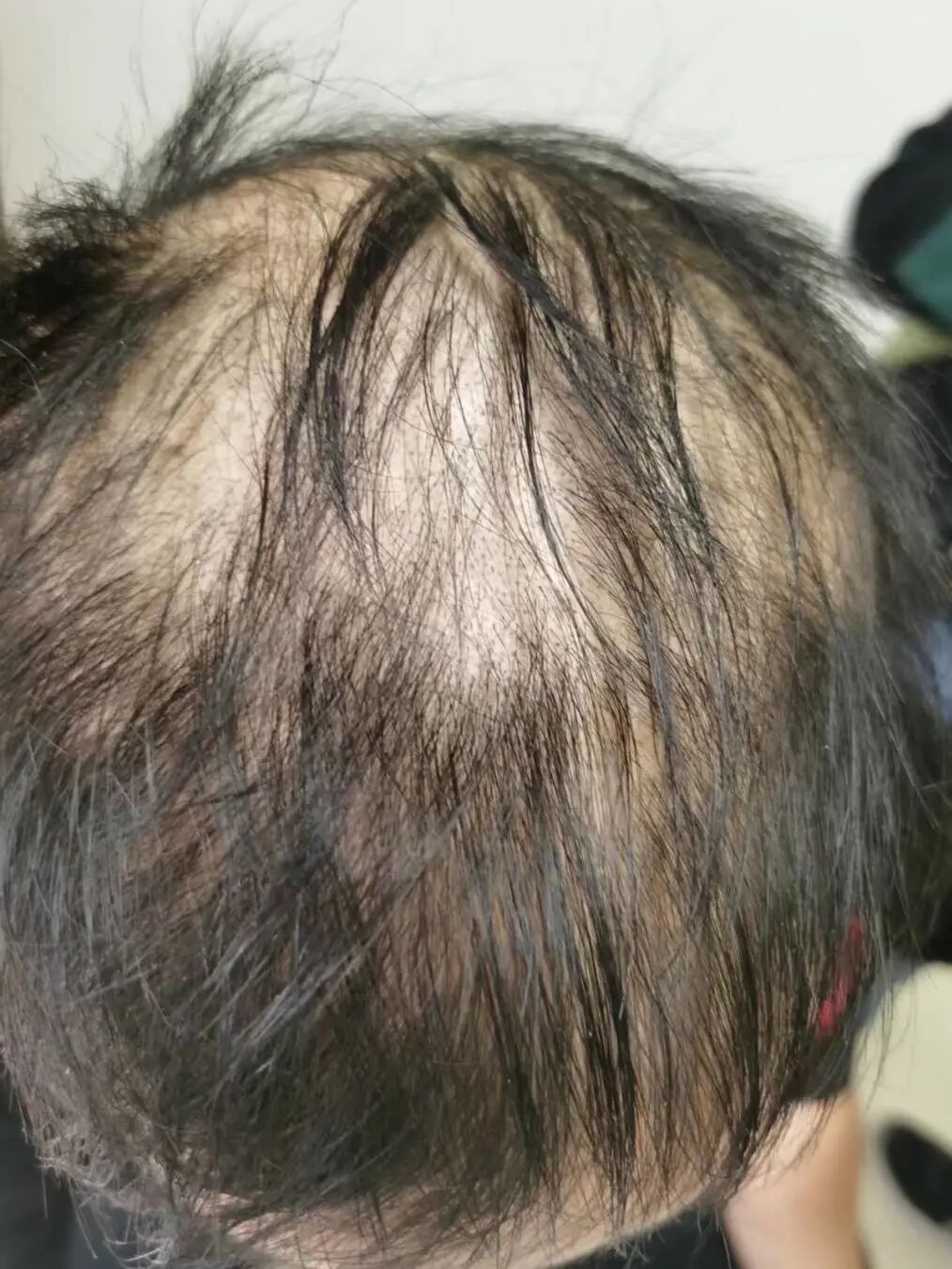 17岁高中生患重症斑秃，这些生活习惯害了他！医生：此病越来越多，最好趁早治疗