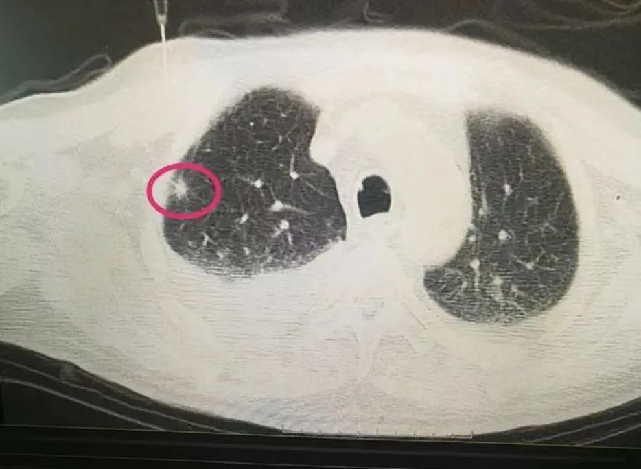 肺部结节 肺部结节