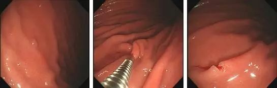 为什么说热活检钳胃肠息肉是怎么长出来的？有什么危害？如何预防和治疗？_https://www.jmylbn.com_新闻资讯_第7张