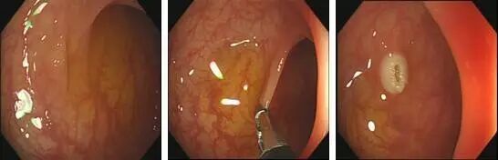 为什么说热活检钳胃肠息肉是怎么长出来的？有什么危害？如何预防和治疗？_https://www.jmylbn.com_新闻资讯_第8张