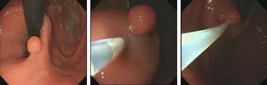 为什么说热活检钳胃肠息肉是怎么长出来的？有什么危害？如何预防和治疗？_https://www.jmylbn.com_新闻资讯_第9张