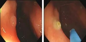 为什么说热活检钳胃肠息肉是怎么长出来的？有什么危害？如何预防和治疗？_https://www.jmylbn.com_新闻资讯_第11张