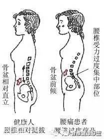 骨科康復：骨盆傾斜怎麼判斷？哪些人容易骨盆傾斜？ 健康 第6張