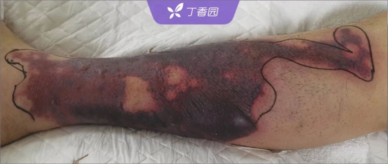 年轻小伙蹲着干活，起身后出现大块淤斑，手指坏死等待截肢！