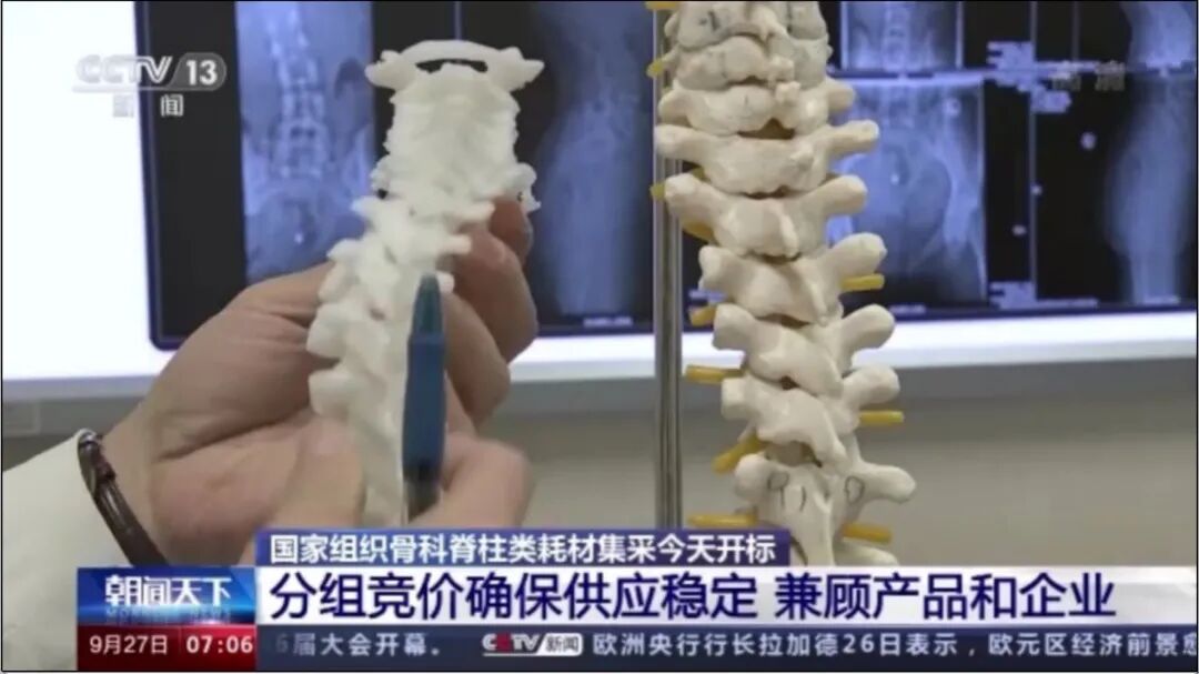 手术耗材是什么高值耗材集采落地半年后，手术医生：厂家明显变懒了_https://www.jmylbn.com_新闻资讯_第1张