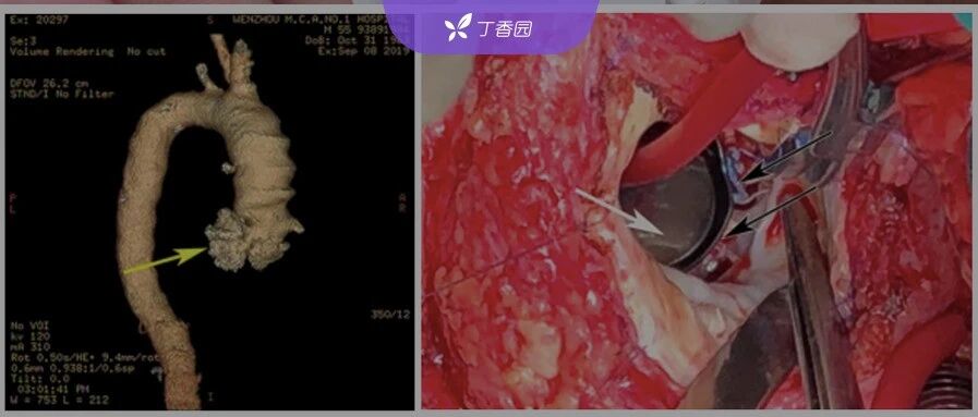 全国首例！诡异心内膜炎背后，藏着绵延 10 年的全球医源性感染