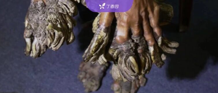 医生每年从他们身上切下 10 斤「树枝」：一半是人，一半是树的怪病患者