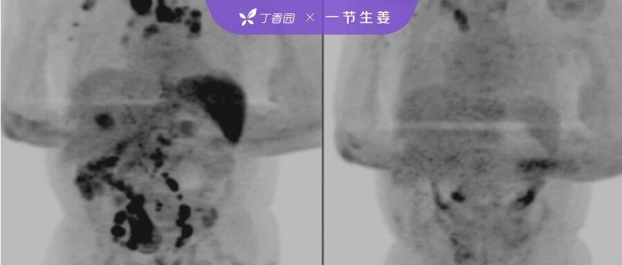 男子感染新冠病毒竟将癌症奇迹治愈？这个刷屏的消息有哪些问题？
